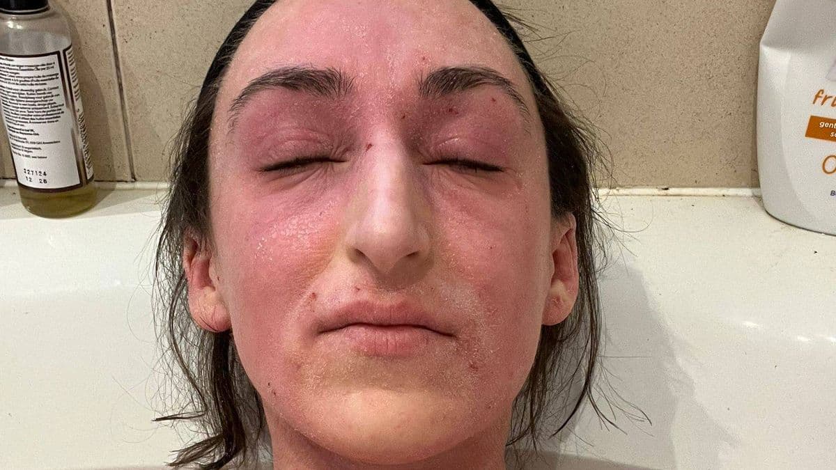 Woman's Skin Turned 'Alien-Like' After 28 Years of Using Steroid Creams