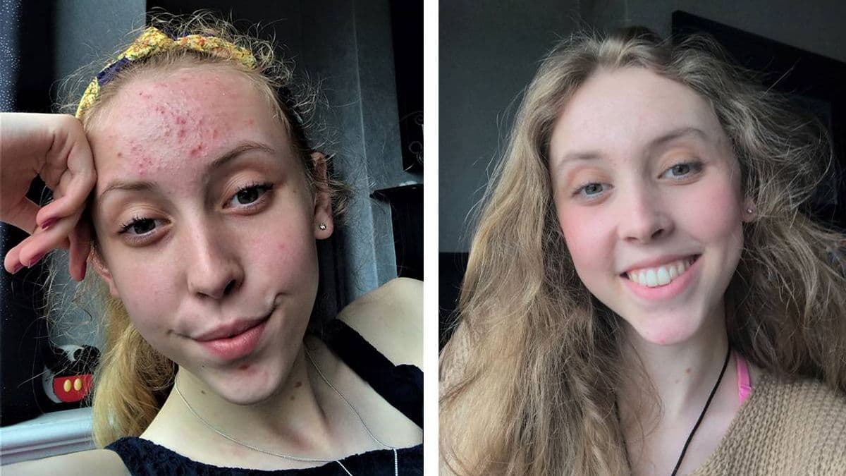 Acne Sufferer Finds £16 Cream That Clears Skin