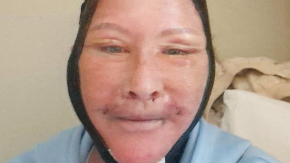 Woman Spends £6,000 on Facelift in Turkey