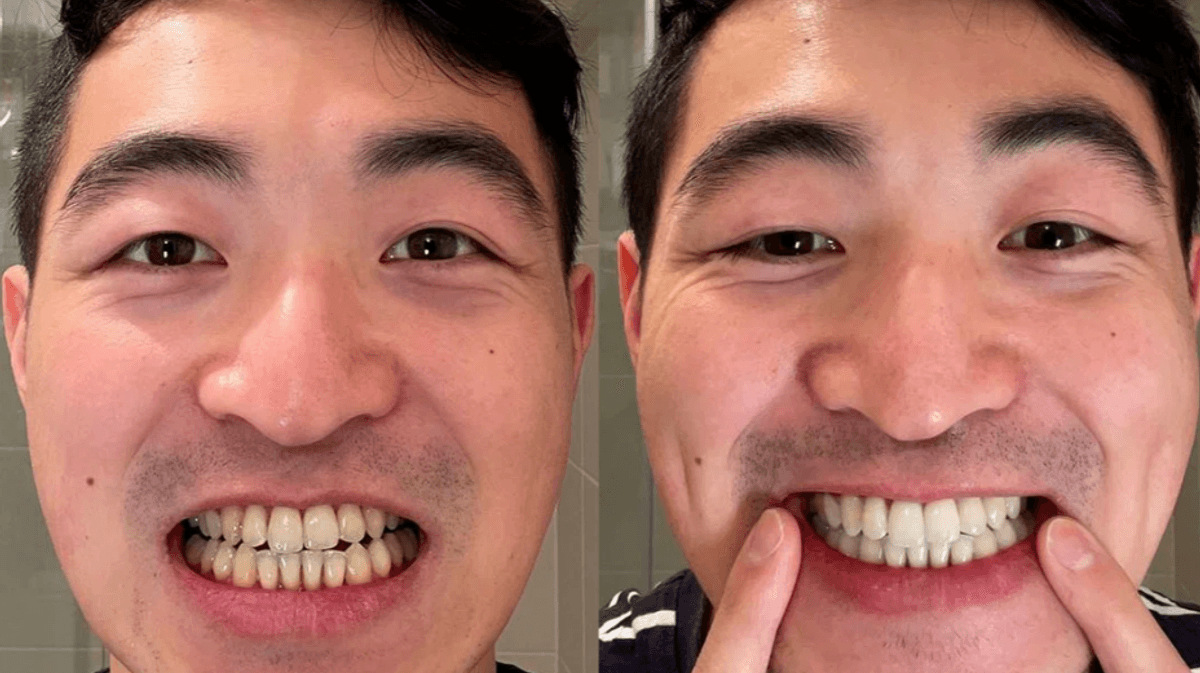 MySweetSmile Offers Cheap Teeth Whitening