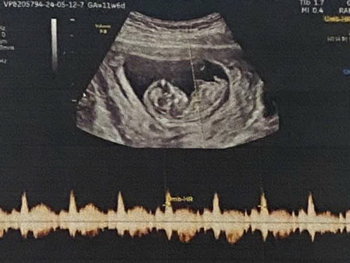 New Vietnam Rules on Fetal Gender Disclosure: What It Means for You
