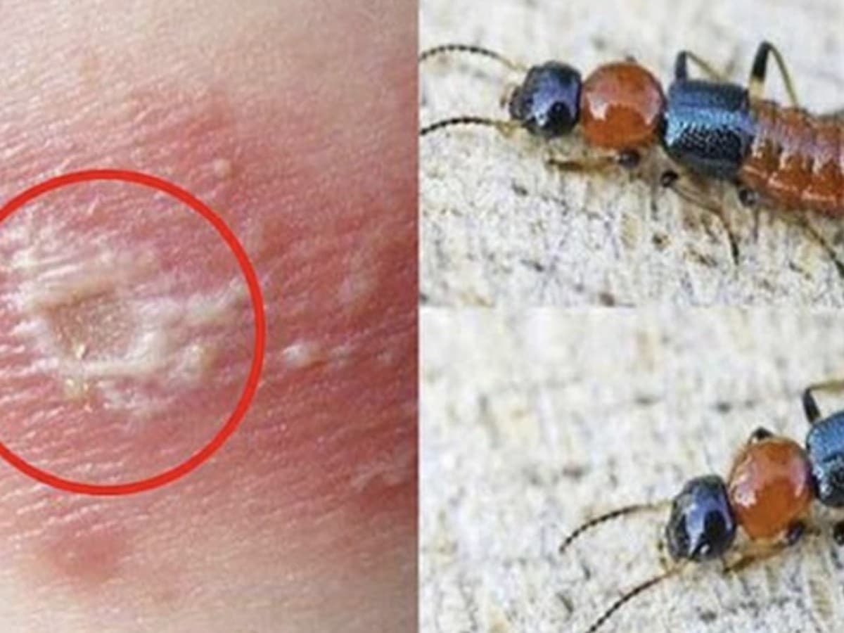 Rove Beetles: How a Tiny Insect Can Cause Burn‑Like Rashes and What to Do