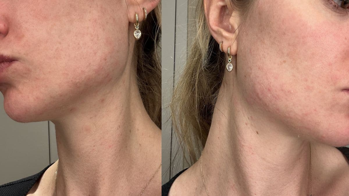 Zoe's Acne Problem During Pregnancy and How She Solved It