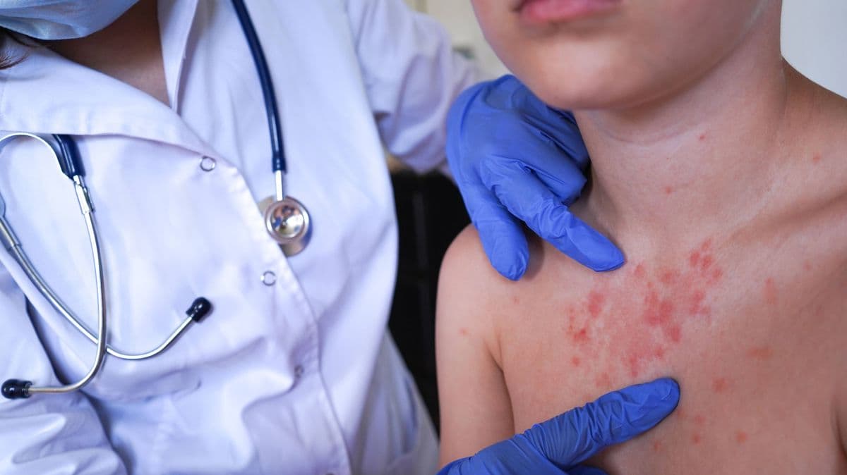 Measles Spreads in the UK, Two Deaths Confirmed